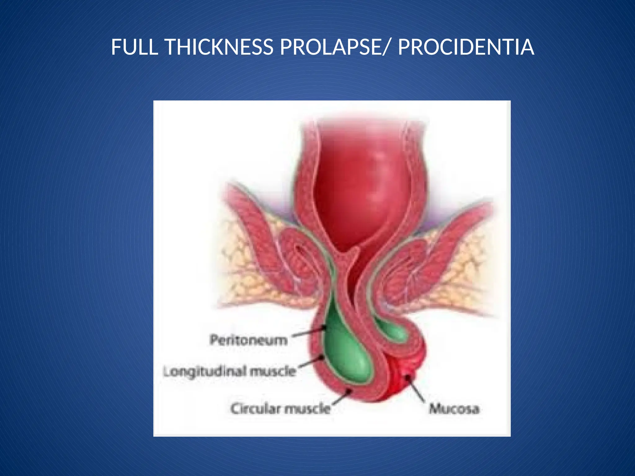 FULL THICKNESS PROLAPSE/ PROCIDENTIA
 