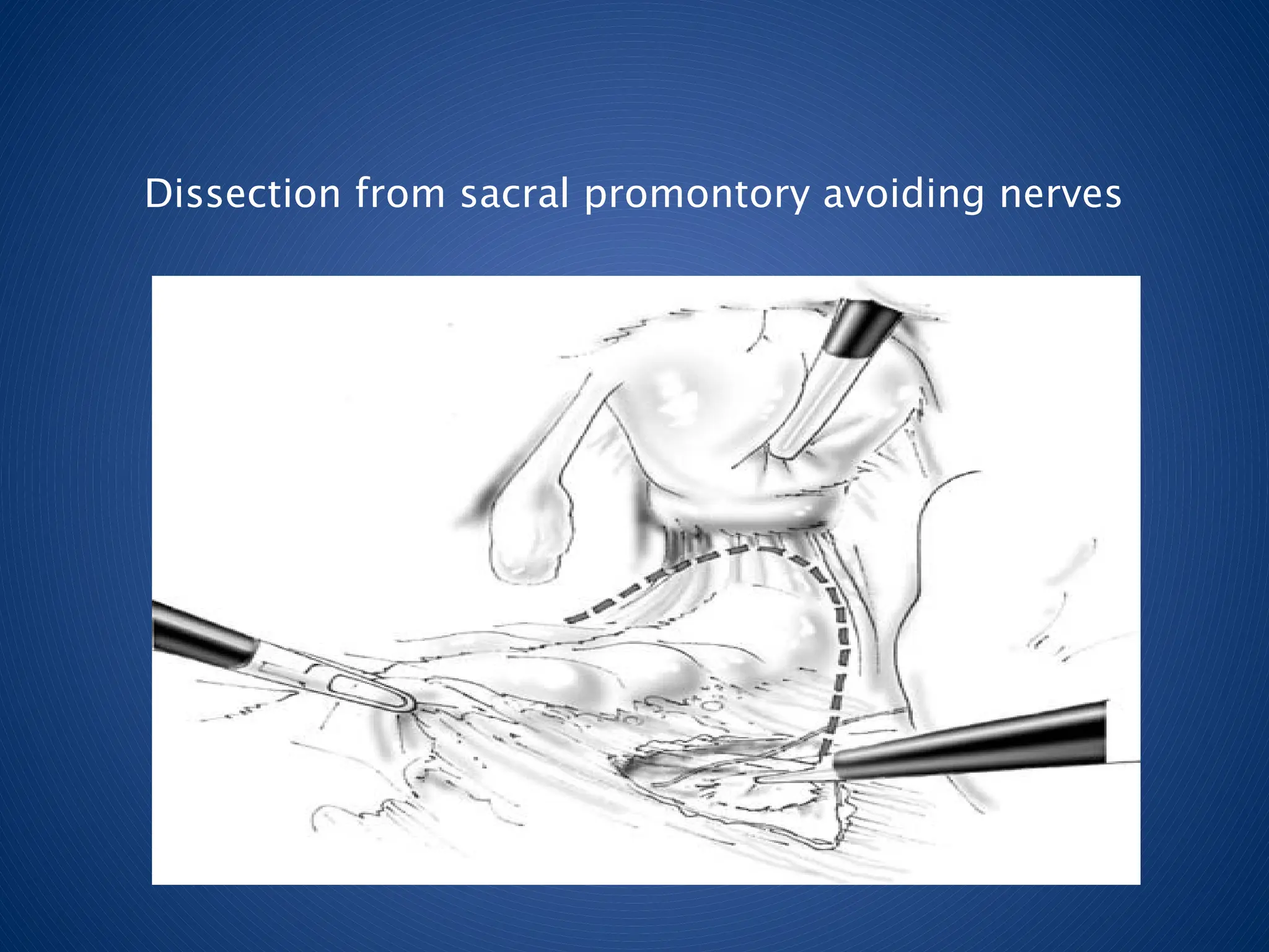 Dissection from sacral promontory avoiding nerves
 