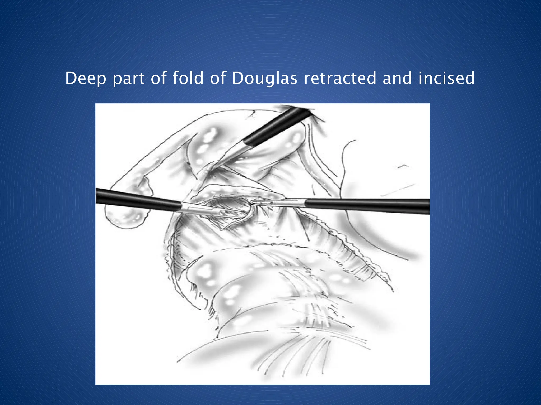 Deep part of fold of Douglas retracted and incised
 