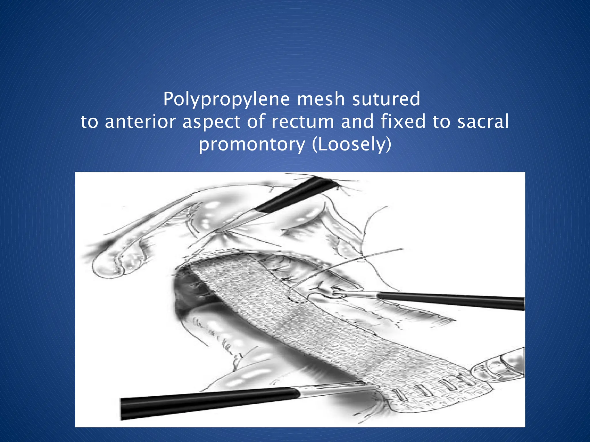 Polypropylene mesh sutured
to anterior aspect of rectum and fixed to sacral
promontory (Loosely)
 