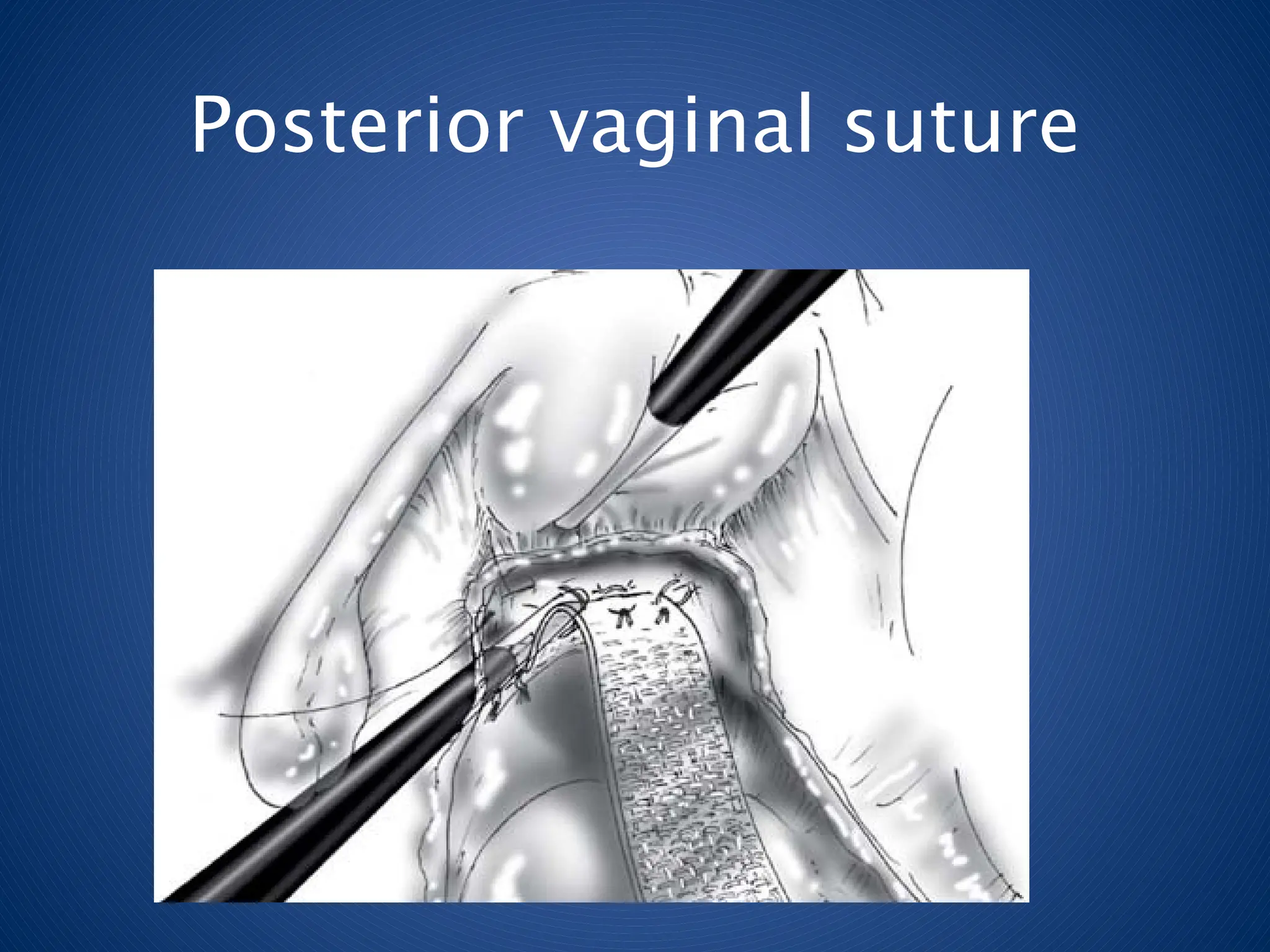 Posterior vaginal suture
 