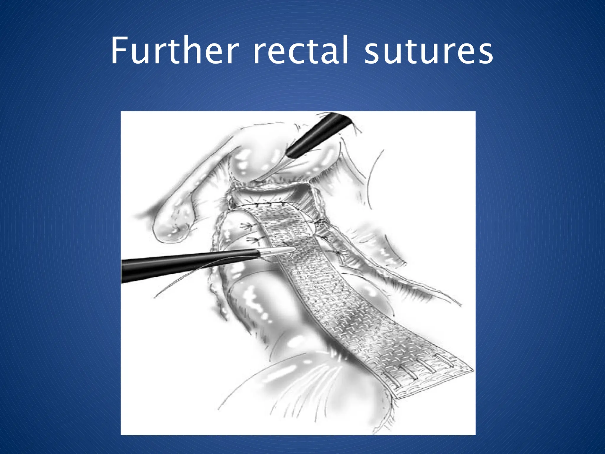 Further rectal sutures
 