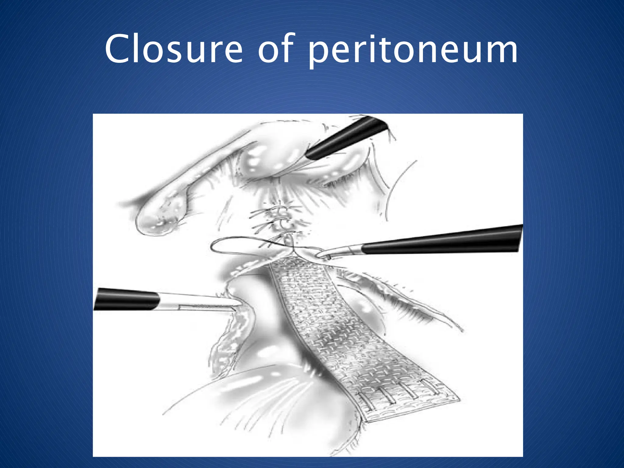 Closure of peritoneum
 