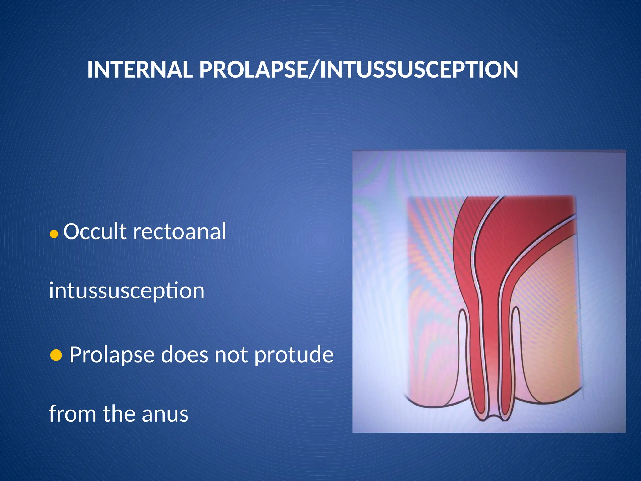 INTERNAL PROLAPSE/INTUSSUSCEPTION
● Occult rectoanal
intussusception
● Prolapse does not protude
from the anus
 