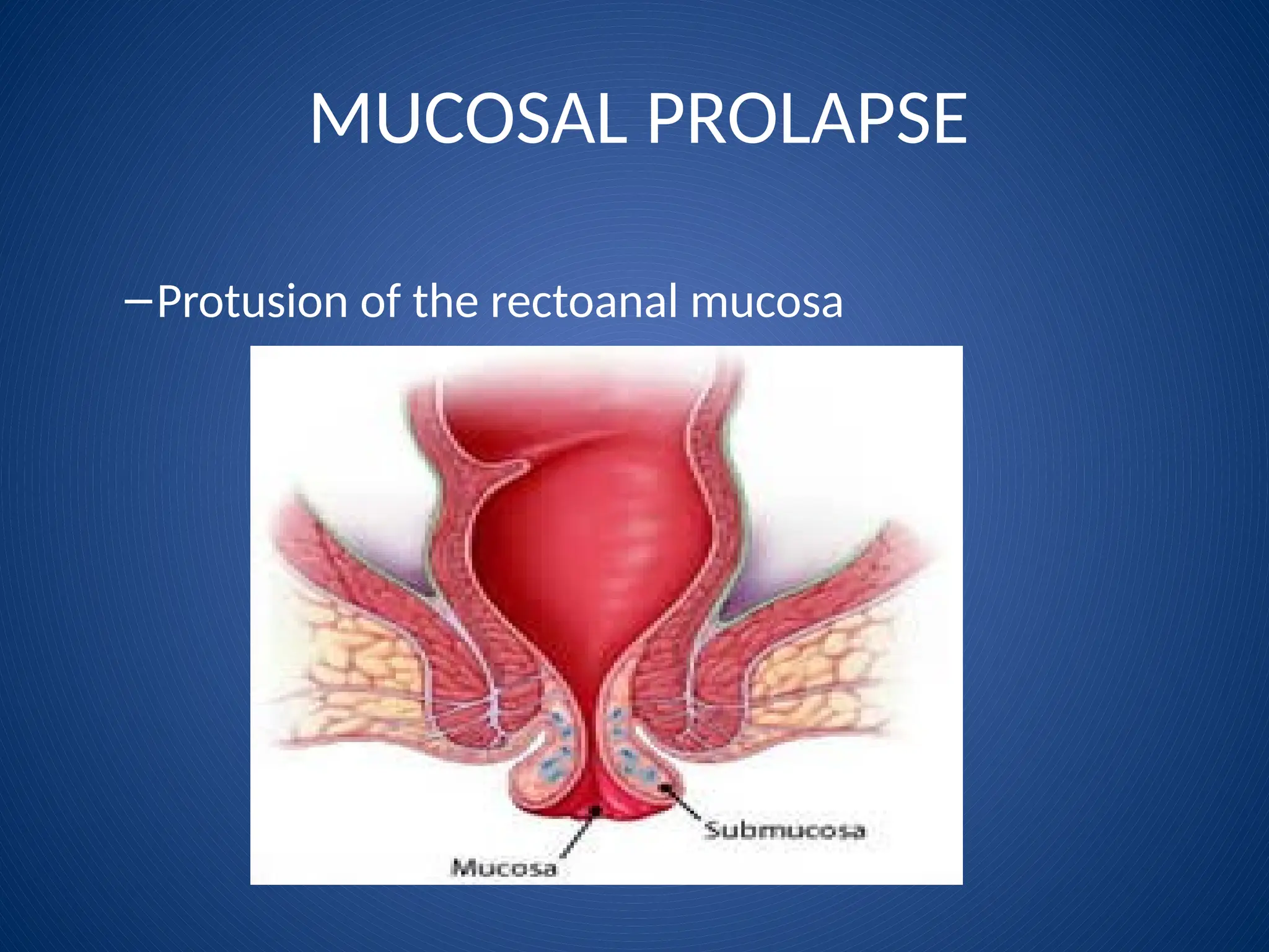 MUCOSAL PROLAPSE
–Protusion of the rectoanal mucosa
 