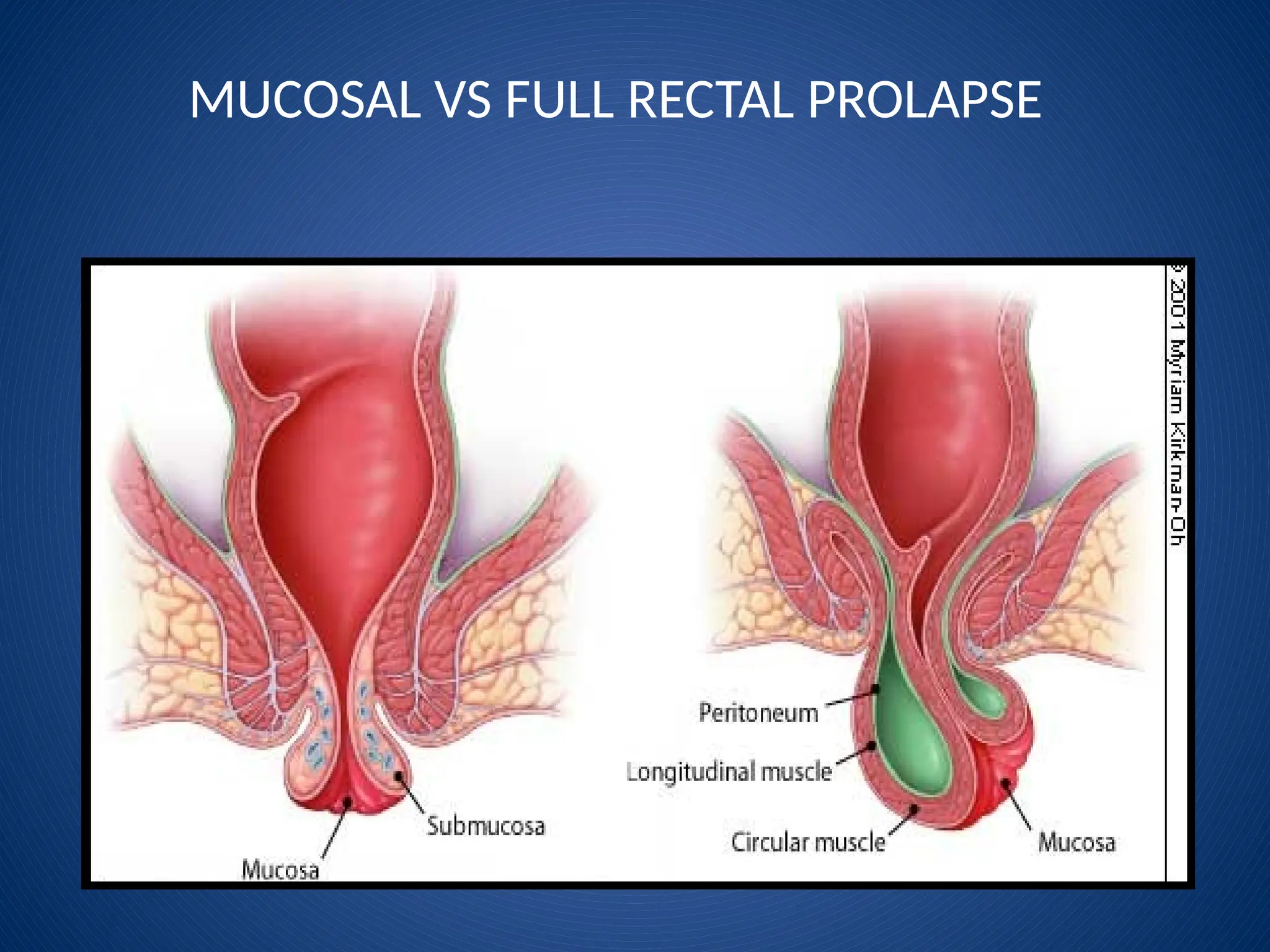 MUCOSAL VS FULL RECTAL PROLAPSE
 