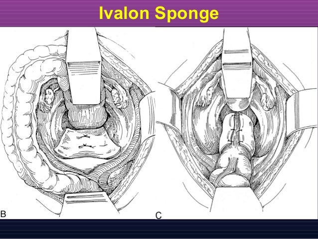 Rectal Prolapse Cedars Sinai Medical Center Medicine
