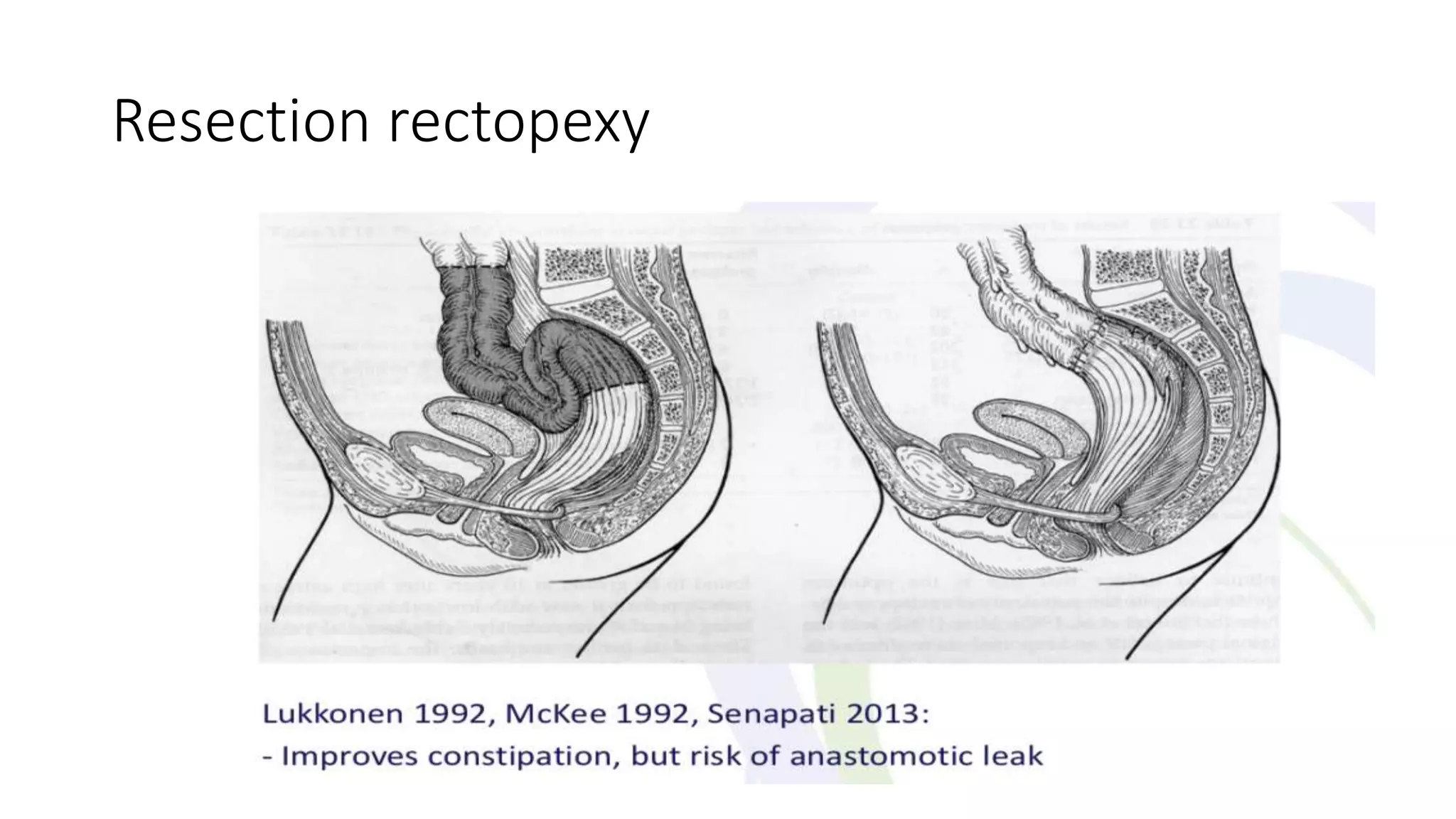 Rectal prolapse: Do we really have a perfect surgical solution? pptx ...