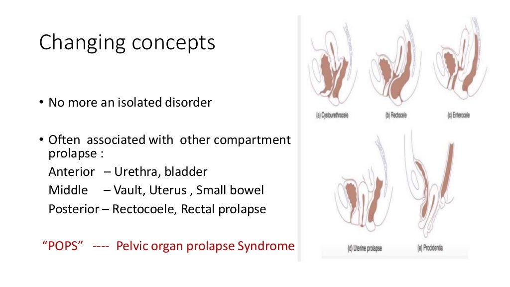 Rectal prolapse Do we really have a perfect surgical solution? pptx