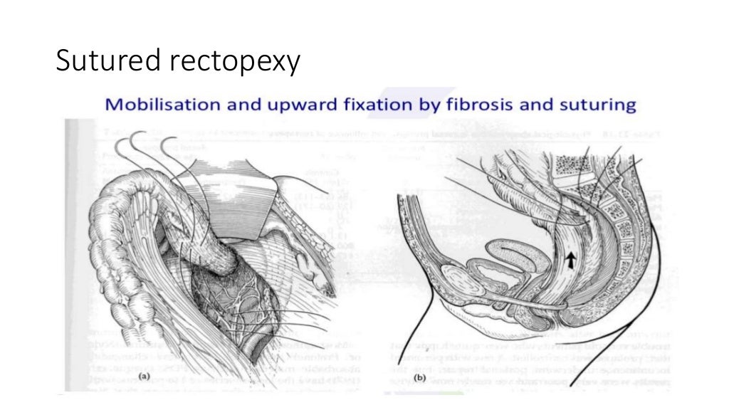 Rectal prolapse Do we really have a perfect surgical solution? pptx