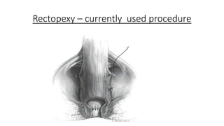 Rectal prolapse pathophysiology and management | PPTX