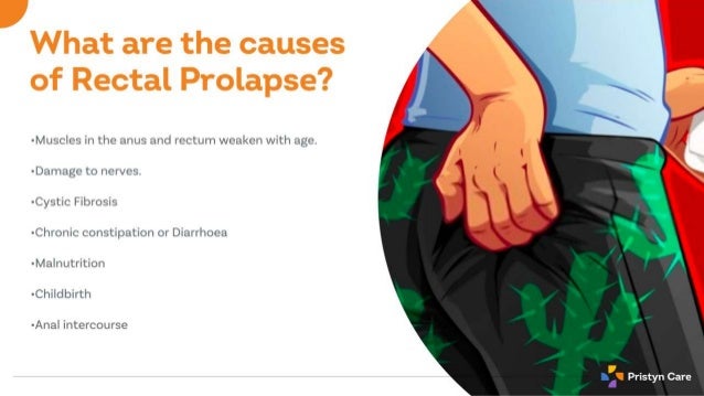 Rectal Prolapse - Causes, Symptoms & Treatment