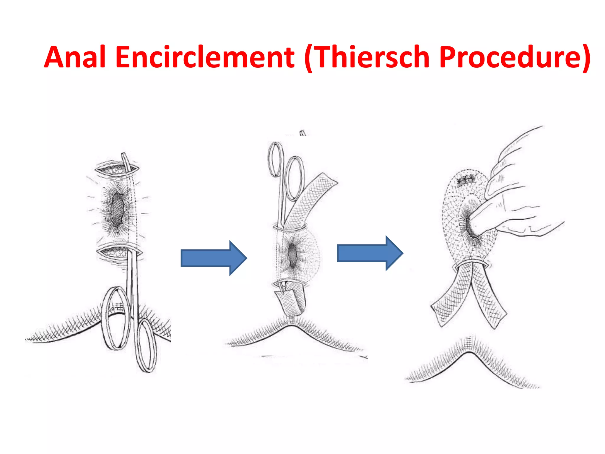 Rectal prolapse surgical approaches | PPTX