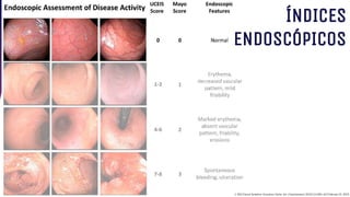 ÍNDICES
ENDOSCÓPICOS
1. ACG Clinical Guideline: Ulcerative Colitis. Am J Gastroenterol 2019;114:384–413.February 22, 2019
 