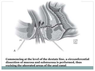 Commencing at the level of the dentate line, a circumferential
dissection of mucosa and submucosa is performed, thus
excising the ulcerated areas of the anal canal.
 