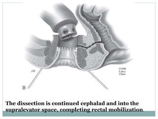 The dissection is continued cephalad and into the
supralevator space, completing rectal mobilization.
 