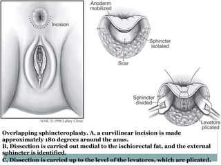 Overlapping sphincteroplasty. A, a curvilinear incision is made
approximately 180 degrees around the anus.
B, Dissection is carried out medial to the ischiorectal fat, and the external
sphincter is identified.
C, Dissection is carried up to the level of the levatores, which are plicated.
 