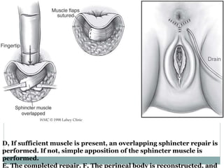 D, If sufficient muscle is present, an overlapping sphincter repair is
performed. If not, simple apposition of the sphincter muscle is
performed.
E, The completed repair. F, The perineal body is reconstructed, and
 