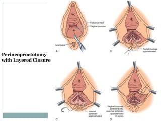 Perineoproctotomy
with Layered Closure
 
