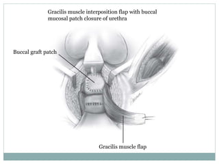Gracilis muscle flap
Buccal graft patch
Gracilis muscle interposition flap with buccal
mucosal patch closure of urethra
 