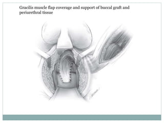 Gracilis muscle flap coverage and support of buccal graft and
periurethral tissue
 