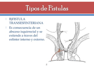 



B)FISTULA
TRANSESFINTERIANA
Es consecuencia de un
absceso isquirrectal y se
extiende a traves del
esfinter interno y externo.

 