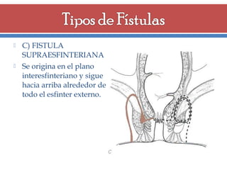 



C) FISTULA
SUPRAESFINTERIANA
Se origina en el plano
interesfinteriano y sigue
hacia arriba alrededor de
todo el esfinter externo.

 