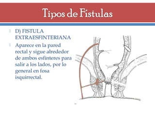 



D) FISTULA
EXTRAESFINTERIANA
Aparece en la pared
rectal y sigue alrededor
de ambos esfinteres para
salir a los lados, por lo
general en fosa
isquirrectal.

 