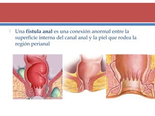 

Una fistula anal es una conexión anormal entre la
superficie interna del canal anal y la piel que rodea la
región perianal

 