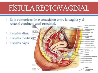 

Es la comunicación o conexicion entre la vagina y el
recto, ó conducto anal proximal.



Fistulas altas.
Fistulas medias.
Fistulas bajas.




 