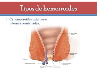 

C) hemorroides externas e
internas combinadas.

 