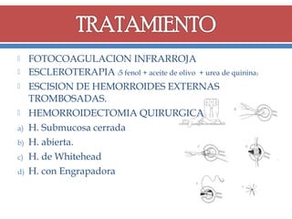




a)
b)
c)
d)

FOTOCOAGULACION INFRARROJA
ESCLEROTERAPIA (5 fenol + aceite de olivo + urea de quinina)
ESCISION DE HEMORROIDES EXTERNAS
TROMBOSADAS.
HEMORROIDECTOMIA QUIRURGICA
H. Submucosa cerrada
H. abierta.
H. de Whitehead
H. con Engrapadora

 
