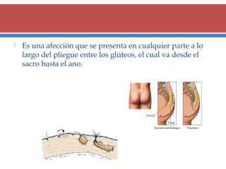 

Es una afección que se presenta en cualquier parte a lo
largo del pliegue entre los glúteos, el cual va desde el
sacro hasta el ano.

 