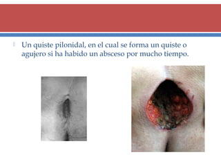 

Un quiste pilonidal, en el cual se forma un quiste o
agujero si ha habido un absceso por mucho tiempo.

 