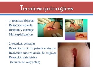 









1. tecnicas abiertas
Reseccion abierta
Incision y curetaje
Marzupializacion
2.-tecnicas cerradas
Reseccion y cierre primario simple
Reseccion mas rotacion de colgajos
Reseccion asimetrica
(tecnica de karydakis)

 