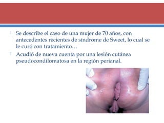 



Se describe el caso de una mujer de 70 años, con
antecedentes recientes de síndrome de Sweet, lo cual se
le curó con tratamiento…
Acudió de nueva cuenta por una lesión cutánea
pseudocondilomatosa en la región perianal.

 