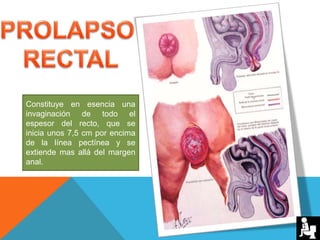 Constituye en esencia una
invaginación de todo el
espesor del recto, que se
inicia unos 7,5 cm por encima
de la línea pectínea y se
extiende mas allá del margen
anal.
 