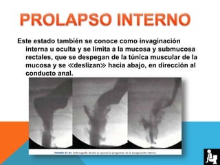 Este estado también se conoce como invaginación
interna u oculta y se limita a la mucosa y submucosa
rectales, que se despegan de la túnica muscular de la
mucosa y se ≪deslizan≫ hacia abajo, en dirección al
conducto anal.
 