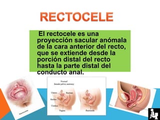 El rectocele es una
proyección sacular anómala
de la cara anterior del recto,
que se extiende desde la
porción distal del recto
hasta la parte distal del
conducto anal.
 