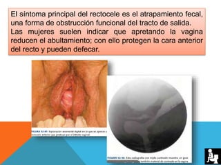 El síntoma principal del rectocele es el atrapamiento fecal,
una forma de obstrucción funcional del tracto de salida.
Las mujeres suelen indicar que apretando la vagina
reducen el abultamiento; con ello protegen la cara anterior
del recto y pueden defecar.
 