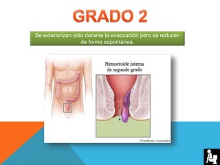 Se exteriorizan sólo durante la evacuación pero se reducen
de forma espontánea.
 