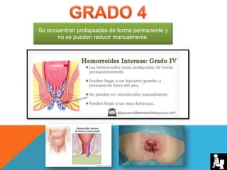 Se encuentran prolapsadas de forma permanente y
no se pueden reducir manualmente.
 