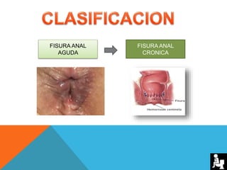 FISURA ANAL
CRONICA
FISURA ANAL
AGUDA
 