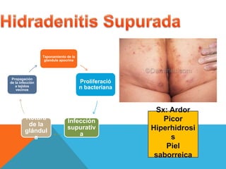 Taponamiento de la
glandula apocrina
Proliferació
n bacteriana
Infección
supurativ
a
Rotura
de la
glándul
a
Propagación
de la infección
a tejidos
vecinos
Sx: Ardor
Picor
Hiperhidrosi
s
Piel
saborreica
 