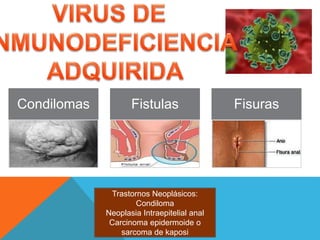 Trastornos Neoplásicos:
Condiloma
Neoplasia Intraepitelial anal
Carcinoma epidermoide o
sarcoma de kaposi
Condilomas Fistulas Fisuras
 