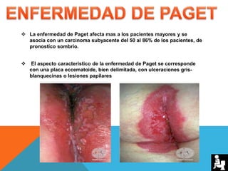  La enfermedad de Paget afecta mas a los pacientes mayores y se
asocia con un carcinoma subyacente del 50 al 86% de los pacientes, de
pronostico sombrio.
 El aspecto caracteristico de la enfermedad de Paget se corresponde
con una placa eccematoide, bien delimitada, con ulceraciones gris-
blanquecinas o lesiones papilares
 