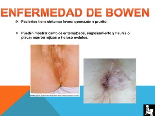  Pacientes tiene síntomas leves: quemazón o prurito.
 Pueden mostrar cambios eritematosos, engrosamiento y fisuras o
placas marrón rojizas o incluso nódulos.
 