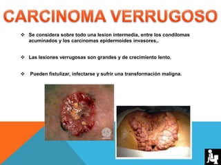 Se considera sobre todo una lesion intermedia, entre los condilomas
acuminados y los carcinomas epidermoides invasores,.
 Las lesiones verrugosas son grandes y de crecimiento lento.
 Pueden fistulizar, infectarse y sufrir una transformación maligna.
 