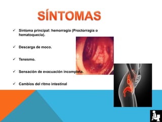  Síntoma principal: hemorragia (Proctorragia o
hematoquecia).
 Descarga de moco.
 Tenesmo.
 Sensación de evacuación incompleta.
 Cambios del ritmo intestinal
 