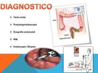  Tacto rectal
 Proctosigmoidoscopia
 Ecografia endorectal
 IRM
 Endoscopia / Biopsia
 
